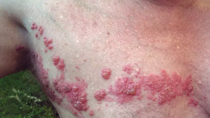 Forgot your shingles shot? These sufferers wish they hadn’t