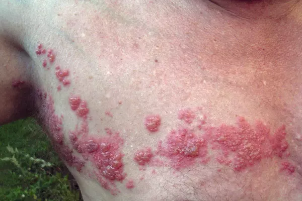 Forgot your shingles shot? These sufferers wish they hadn’t