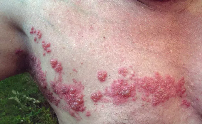 Keep forgetting your shingles shot? These sufferers wish they hadn’t